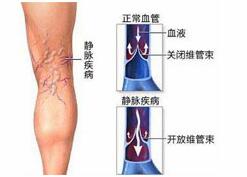 预防静脉血栓 拒当“久坐族”