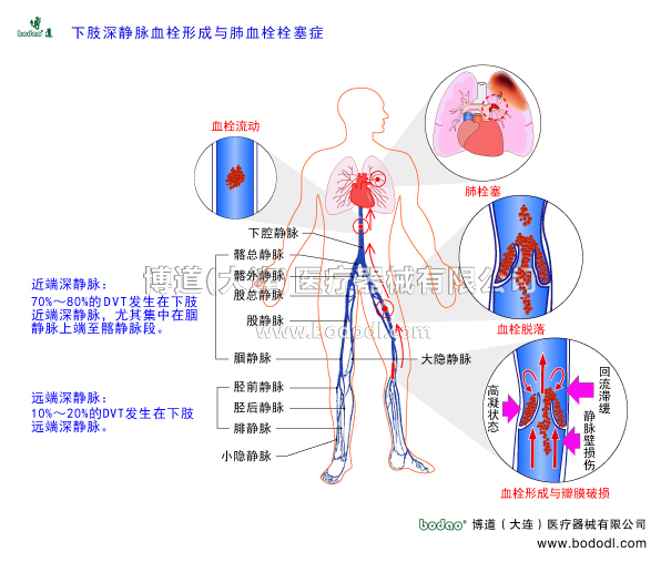 深静脉血栓形成的预防与护理