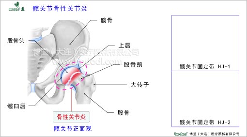 髋关节疾病与健康护理