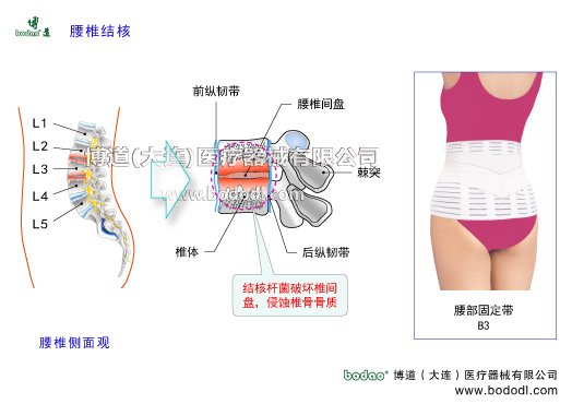 腰椎结核龟背炎的发病原因及治疗方法与康复护理。腰椎结核的症状与治疗，博道医用透气性腰部固定带腰椎矫正带。脊椎椎体以松质骨为主结核菌，寒性脓肿结核脓肿肉芽组织椎间盘坏死，上腰椎结核可有大腿痛，下腰椎结核可有放射状的坐骨神经痛。腰部强直腰椎关节活动受限，出现成角后凸畸形强直性脊柱炎化脓性脊柱炎腰椎间盘突出。脊柱肿瘤退行性脊椎骨关节病以腰部固定带等护腰支具固定为辅，透气护腰带腰围腰托腰椎固定支具腰疼带