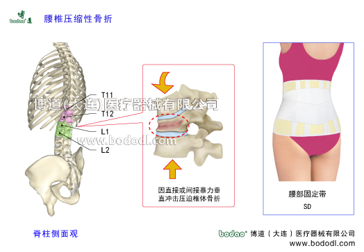 胸腰椎压缩性骨折的发生原因、症状及治疗。胸腰段压缩性骨折的主要原因一是因间接暴力致伤及老年人骨质疏松或肌肉瞬间强力收缩等所造成的创伤，二是因直接暴力致伤。另外，骨结核、骨肿瘤等疾病也可导致椎骨压缩性骨折。博道腰椎固定带透气性医用护腰的功能与防护作用。胸腰椎压缩性骨折的易发部位及保守治疗和手术治疗方法。为什么胸腰段容易发生椎体压缩性骨折。日本透气性护腰带腰椎部骨折支具，博道透气性医用腰部固定带