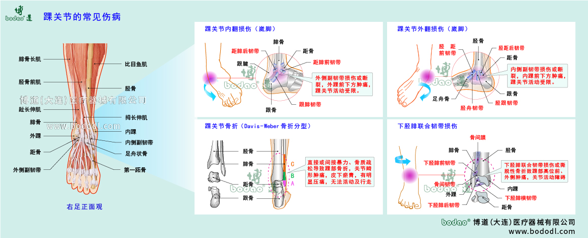 踝关节伤病的类型与症状