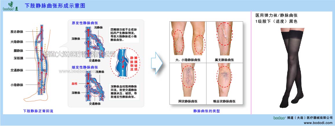 下肢静脉曲张与健康防护